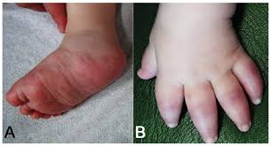 Spectrum Of Genetic Autoinflammatory Diseases Presenting With Cutaneous Symptoms Html Acta Dermato Venereologica