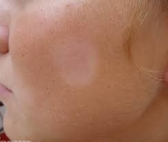 The university of michigan 6. Pityriasis Alba Pictures Causes Symptoms Treatment Hubpages