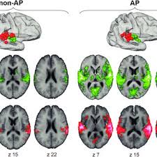 Ejecting silly preconceptions and cultural definitions of what a man is. Pdf Increased Volume And Function Of Right Auditory Cortex As A Marker For Absolute Pitch