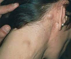 Lymphoma ( limfoma ) adalah sejenis kanser yang berkaitan dengan pembelahan secara tidak nota: Apa Itu Kanser Limfoma Ini Perkara Yang Korang Perlu Ambil Tahu Remaja