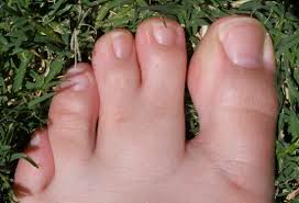 Hand's malformations in poland's syndrome are rare in your study, they touch only 12% patients. Poland Syndrome Symptoms Causes Treatment And More