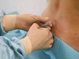 Complicacion De La Epidural Del Parto Anestesiar