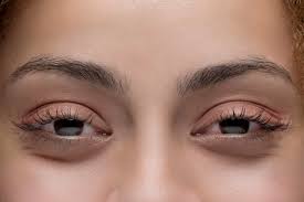 While somewhat uncommon at low blood thc concentrations, it becomes increasingly common as blood thc concentrations increase. Why Does Weed Make Your Eyes Red Weedmaps