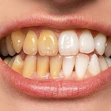 Dental Fluorosis In Bangalore