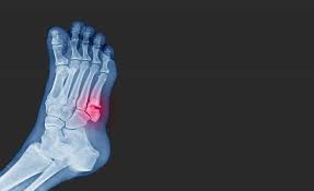 Image result for Foot Fracture