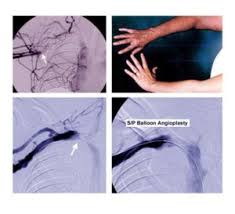 Venous Thoracic Outlet Syndrome Tos Center For Thoracic Outlet Syndrome