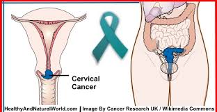 If menopause starts after treatment, your periods usually stop sooner than they would naturally or straight away, and you may have other symptoms of menopause sooner, such as hot flushes and vaginal dryness. 10 Warning Signs Of Cervical Cancer You Shouldn T Ignore
