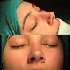 Findik Burun Rinoplasti Rhinoplasty Nose Nosejob Burunestetigi Estetikburun Estetikburunameliyati Ardapelen Beautiful Nose Profile Health And Be Rhinoplasty Nose Jobs Nose Surgery Rhinoplasty Nose Job