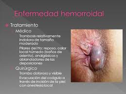 Hemorrhoids on the inside are called internal hemorrhoids, and those on the outside are called external hemorrhoids. Patologia Orificial Benigna Ppt Video Online Descargar