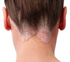 Image result for psoriasis