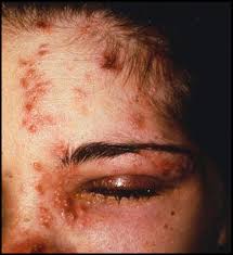 Image result for herpes zoster
