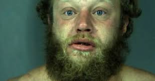 Judge Feeney Declines to Condemn Mentally Ill Arcata Man to Three Years in  Prison