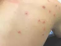 Image result for Papular urticaria