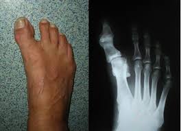 Image result for Hallux Varus