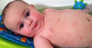 Skincare untuk kulit kering itu gampang gampang susah. 4 Penyebab Kulit Bayi Kering Yang Harus Mama Tahu Popmama Com