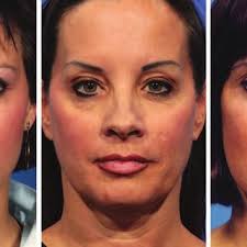 (Left) Age 26 years. (Center) Preoperatively at age 52 years. (Right)...