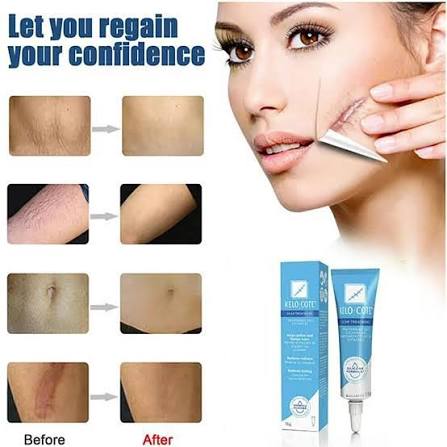 SWIPE >> KUONA REVIEWS ZA KELOCOTE SCAR GEL 👌 Price ; 40,000/= Inaondoa makovu ikiwemo ya 📌Uzazi 📌Ipasuaji (surgery ) 📌Kidonda kupona kuacha kovu 📌Keloids 📌Kovu la kuungua Yani inatibu makovu ya