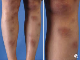 Image result for erythema nodosum