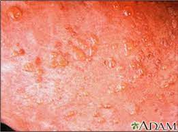 Does Your Gluten Rash Look Like These 5 Photos Gluten Rash Dermatitis Herpetiformis Gluten Allergies Symptoms