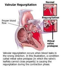 Leaking Heart Valve Symptoms Causes Problems Heart Valves Mitral Valve Prolapse Medical Surgical Nursing