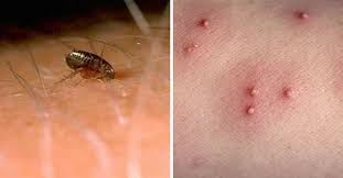 Spider Bites That Look Like Mosquito Bites 12 Common Bug Bites And How To Recognize Each One Ant Bites Bug Bites Bed Bug Bites Remedies