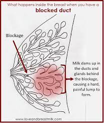Avoid intake of soy products, as too much estrogen can lead to. How To Treat Blocked Ducts Love And Breast Milk