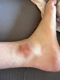 Image result for wolf spider bite skin