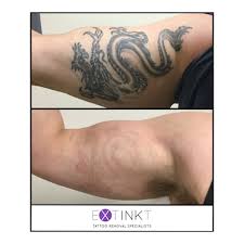 Before After Tattoo Removal Results Laser Tattoo Removal Specialists