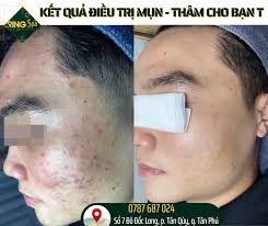 Spa trị mụn Uy tín số 1 quận Tân Phú