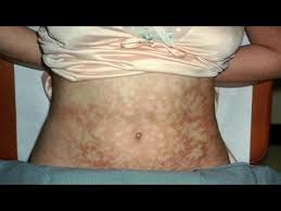 How To Get Rid Of Heating Pad Burns