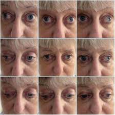 Clinical Reasoning: A 69-Year-Old Woman With Ophthalmoplegia