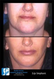 9 Parfitt Facial Cosmetic Surgery ideas