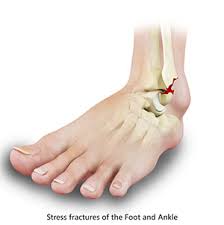 Image result for Foot Fracture