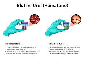 Die ursachen für dieses symptom können sehr vielfältig sein. Blut Im Urin Ursachen Symptome Und Behandlung