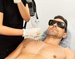 One of the first published articles describing laser hair removal was authored by the group at massachusetts general hospital in 1998. Chatswood Westfield Laser Clinics Australia