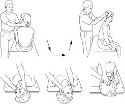Image result for Canalith Repositioning Procedure