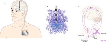 Image result for Thalamic Stimulation