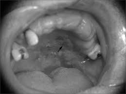 Image result for Erythroplakia roof of mouth
