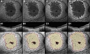 German open championships 2016#pavelpasechnik #martaarndt #jive Progression Of Atrophy And Visual Outcomes In Extensive Macular Atrophy With Pseudodrusen Like Appearance Ophthalmology Science