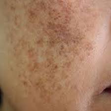 Esto Es Lo Que Significan Las Manchas En La Piel Dependiendo De Su Color Y Forma Manchas Blancas Rojas Rosas Cafes