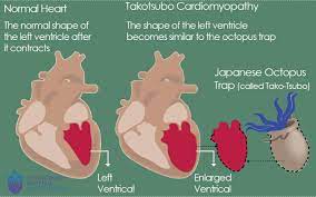 Exercise testing is a form of cardiovascular stress testing that uses exercise with electrocardiography (ecg) and blood pressure monitoring. Takotsubo Cardiomyopathy St Vincent S Heart Health