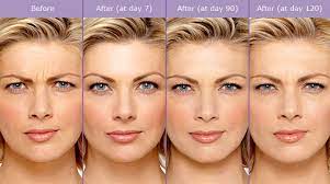100% of the effects of the medication become visible for all patients about 2 weeks after the injection. How Long Does Botox Last Woodlands Dermatology Spring Katy Tx