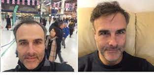 Serkan aygin clinic · cosmedica · smile hair clinic · avrupa hair clinic/goldenhair · sapphire . Trapianto Dei Capelli Un Business Dalla Turchia Alla Puglia Corriere It