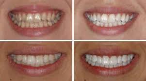 Vedi le offerte per acquistare acqua ossigenata risparmiando! Acqua Ossigenata Per Sbiancare I Denti E Allarme Per La Salute Presenza Di Perossido Di Idrogeno