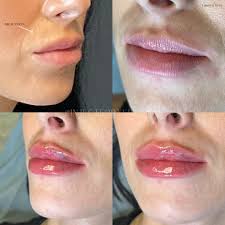 Yeg Medical Aesthetics Spa | Dissolving Lip Filler Migration 💋 ⠀⠀⠀⠀⠀⠀⠀⠀⠀  Precision Matters: When Lip Fillers Wander Off-Course, It Can Lead To  Asymmetry, Unevenness… | Instagram