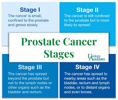 Other than the lymph nodes near the prostate, the most common site of staging is done as part of the diagnosis process to determine how extensive your cancer is within your prostate and whether it has spread to lymph nodes or other organs. Prostate Cancer Stages Options Urology Associates Co