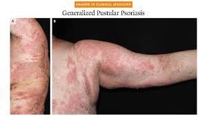 Image result for Generalized Rash