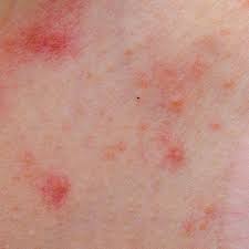 Intertrigo is a skin condition that causes a rash in folds of the skin, such as under the breasts, in the groin, or under the in this article, we describe what intertrigo is, what it looks like, and what causes it. Intertrigo Fort Worth Tx Northstar Dermatology