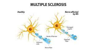 This damage slows down or blocks messages between your brain and your body, leading to the symptoms of ms. Multiple Sclerosis Health Tips Multiple Sclerosis Health Articles Health News Thehealthsite Com