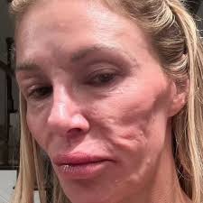 Former #RHOBH star #BrandiGlanville has shared a concerning new selfie  showing off her disfigured face